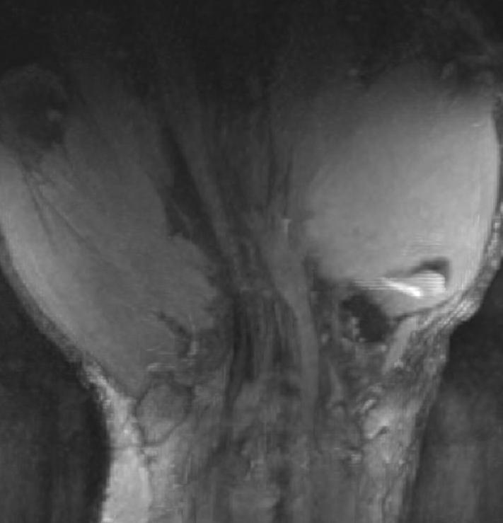 Figure 2 for case Neuroma in continuity